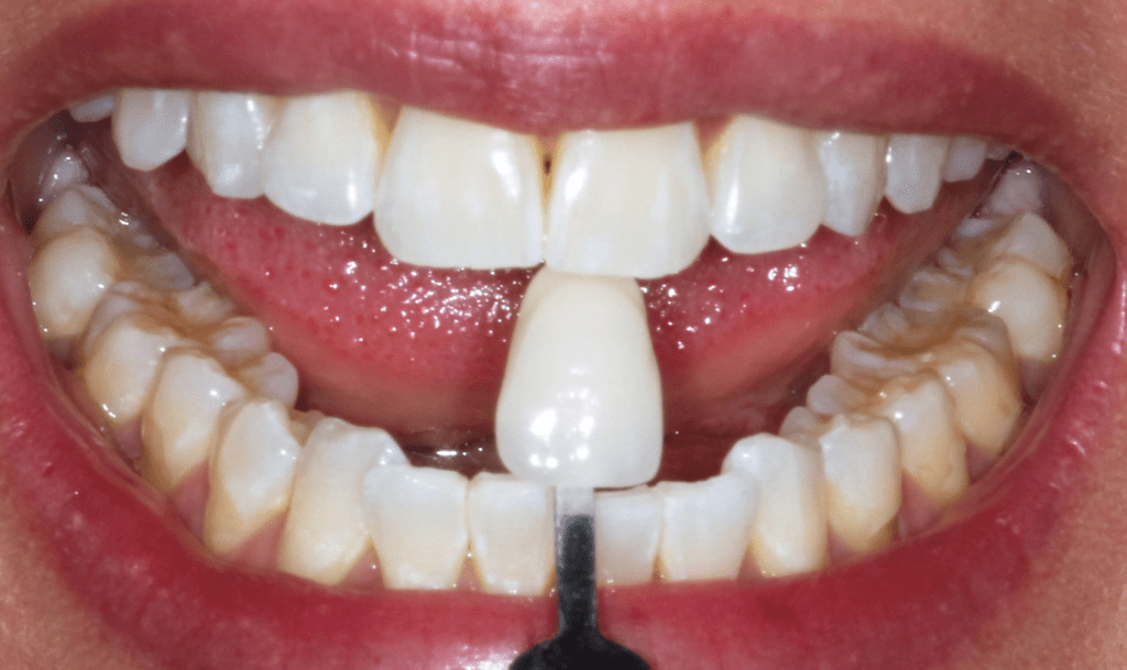 5 Things to Know About Tooth Whitening