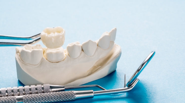 Dental crown model with tools at On Q Dentistry, Portland, OR.