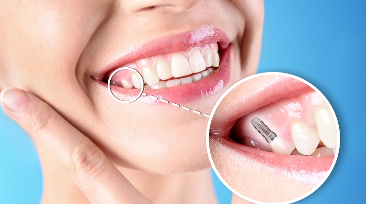 Close-up of a smiling woman with a dental implant illustration, highlighting tooth restoration by On Q Dentistry in Portland, OR.