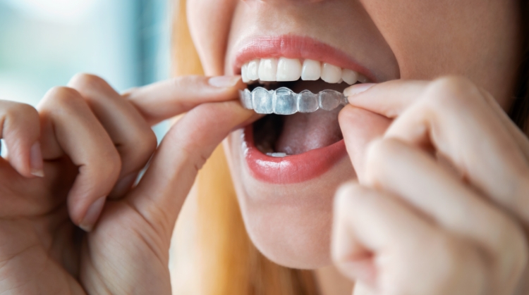 Woman inserting clear Invisalign aligners | On Q Dentistry, Portland, OR