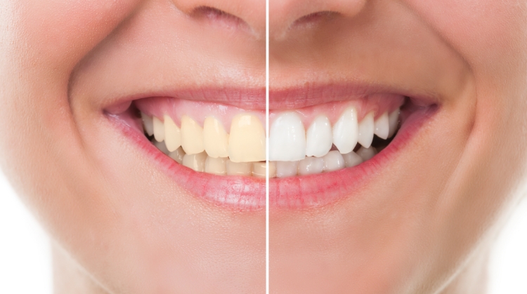 Before and after comparison of a patient's smile showing the results of professional teeth whitening at On Q Dentistry in Portland, OR — left side shows stained teeth, right side shows bright, white teeth.